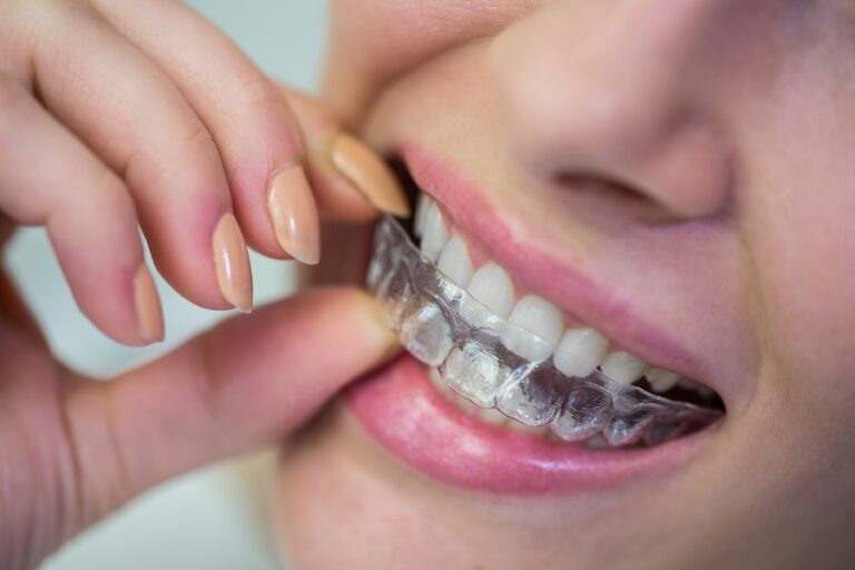 Close-up of woman wearing orthodontic silicone invisible braces