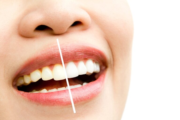 Plano Odontológico com Clareamento Dental: Saúde e Estética no Mesmo Produto.